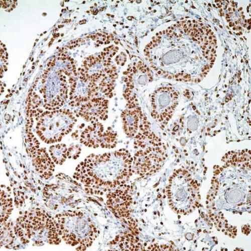 WT1 Antibody Reagent for Immunohistochemistry